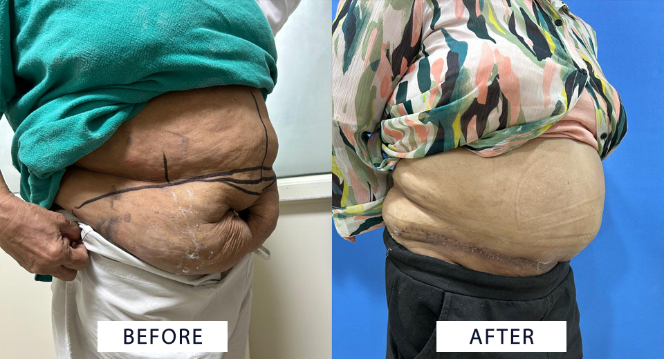 abdominoplasty