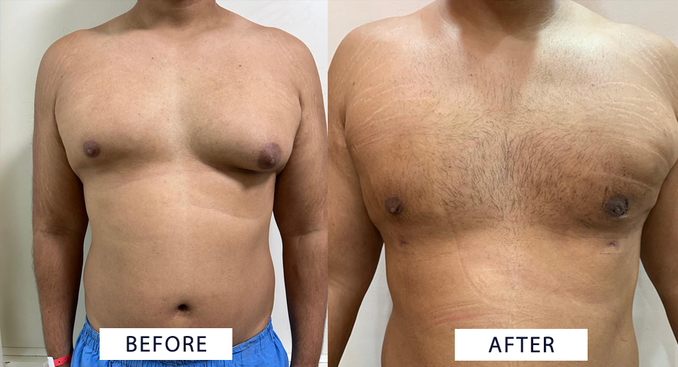 Gynecomastia Surgery