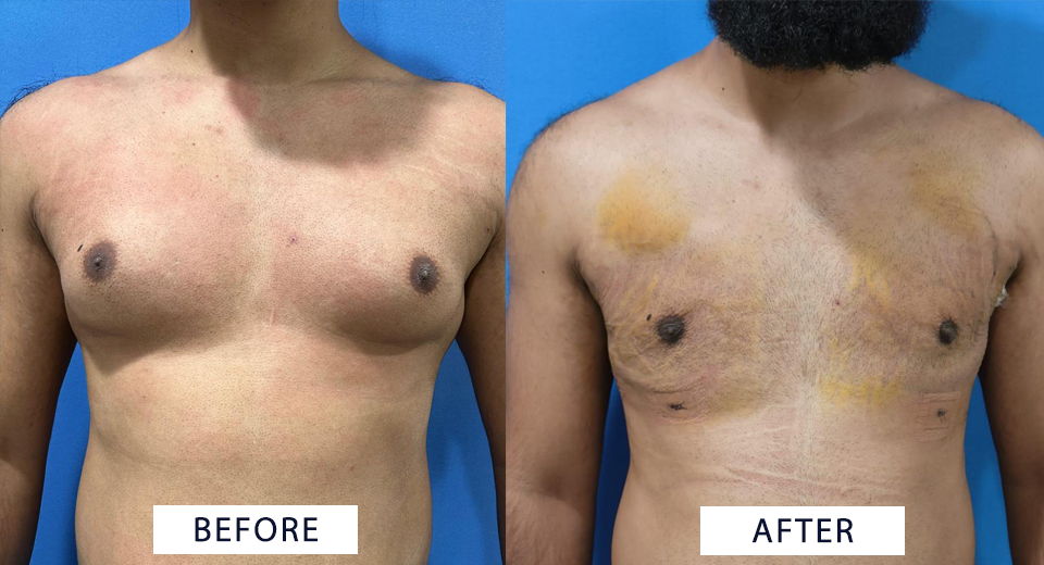 Gynecomastia Surgery