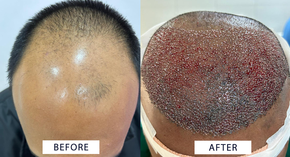 Hair Transplant