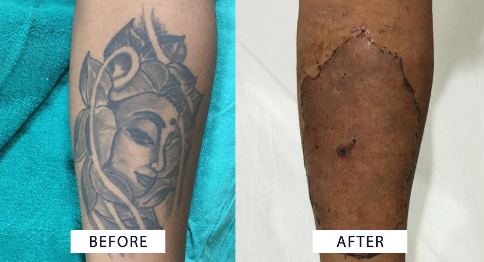 Tattoo Removal